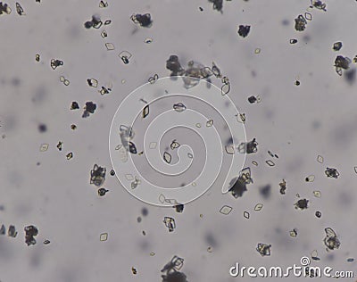 Moderate uric acid crystals in urine Stock Photo