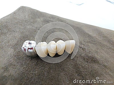 Modern ceramic-metal dental bridge for restoring dentition Stock Photo