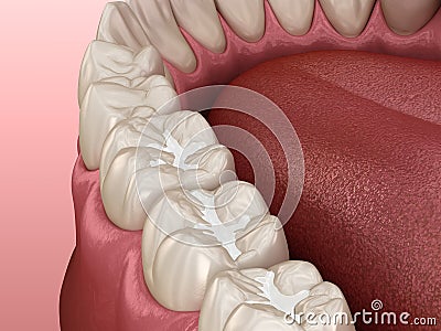 Molar Fissure dental fillings, Medically accurate 3D illustration of dental concept Cartoon Illustration