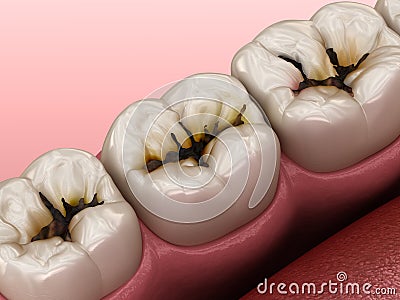 Molar teeth damaged by caries. Medically accurate tooth 3D illustration Cartoon Illustration