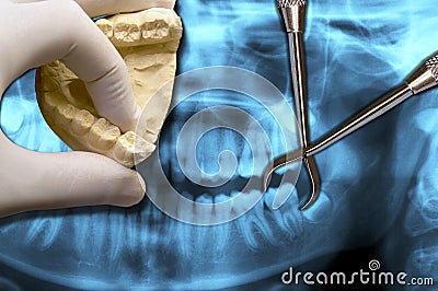 Molar teeth extraction over dental scan Stock Photo