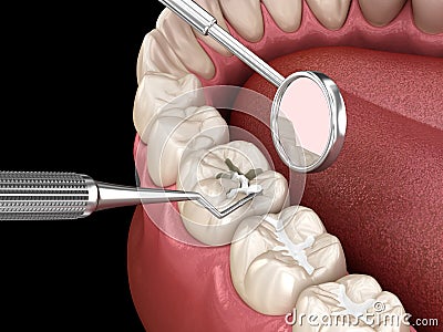 Molar tooth fissure restoration with filling. Medically accurate tooth 3D illustration Cartoon Illustration