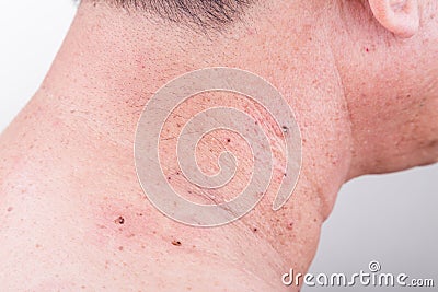 Mole removed via skin graft procedure leaving scar Stock Photo