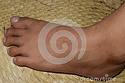 Molluscum Contagiosum infection in foot Stock Photo