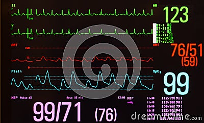 Monitor with Atrial Flutter Stock Photo