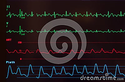 Monitor with Atrial Flutter Stock Photo