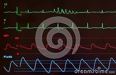 Monitor with Short Run of Ventricular Tachycardia Stock Photo