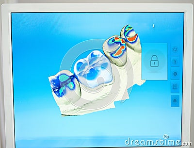 Monitoring your teeth. Shot of a scan of teeth for cavities on a monitor. Stock Photo