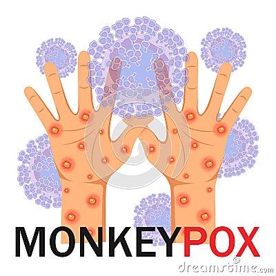 Monkeypox virus. Human hands with a rash Vector Illustration