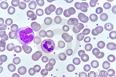 Monocyte and neutrophil cell in blood smear Stock Photo