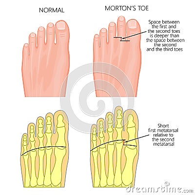 Morton`s toe Vector Illustration