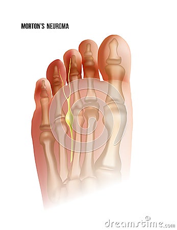 Mortons neuroma. Foot pain strain bottom view. Realistic anatomy illustration Vector Illustration