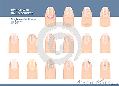 Most Common Nail Disorders and Diseases. Big set. Vector illustration Vector Illustration