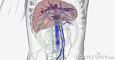 Liver cancer is characterized by tumor growth that begins in the liver cells Stock Photo