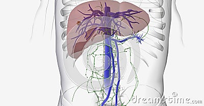 Liver cancer is characterized by tumor growth that begins in the liver cells Stock Photo