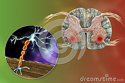 Motor neuron diseases, 3D illustration Cartoon Illustration