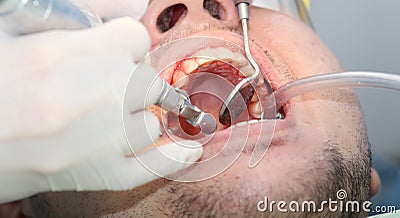 Mouth bleeding at the dentist office Stock Photo