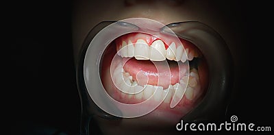 Mouth with bleeding gums on a dark background. Stock Photo