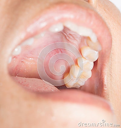 Blisters in the mouth. Infection Stock Photo