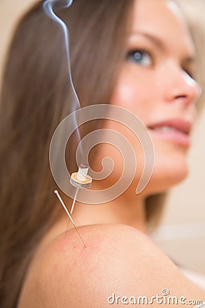 Moxibustion acupunture needles heat on woman Stock Photo