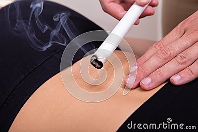 Moxibustion Procedure At Health Center Stock Photo