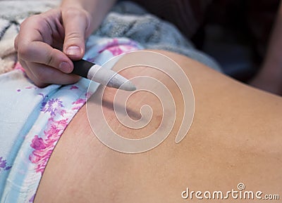 Moxibustion procedure at health centers. Alternative medicine therapist doing moxa treatment on her client. Stock Photo