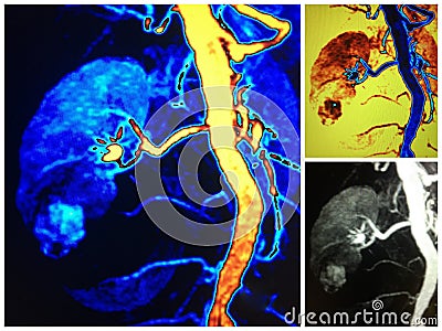 Mra lower pole renal cell carcinoma collage Stock Photo