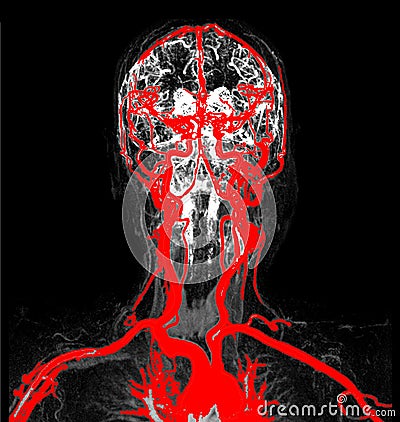 MRA (magnetic resonance angiography) of brain for stroke patient. Stock Photo