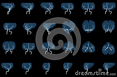 MRA and MRI image of blood vessels in brain for a medical diagnosis cerebrovascular or hemorrhagic stroke Stock Photo