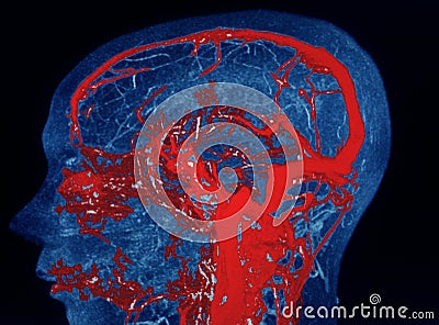 MRA AND MRV OF BRAIN Finding:Bilateral territorial muscles to the cortex and subcortical of the parietal and low hemispheres Stock Photo