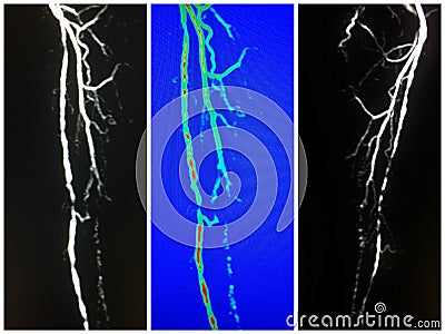 Mra superficial femoral artery occlusion collage Stock Photo