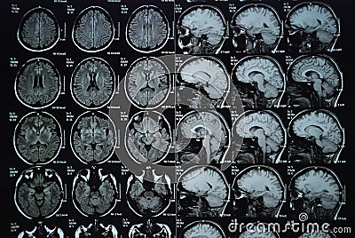 MRI Stock Photo