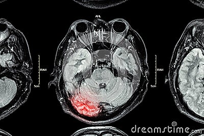 MRI of brain : brain injury Stock Photo
