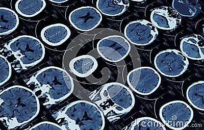 MRI of brain and cranium Stock Photo