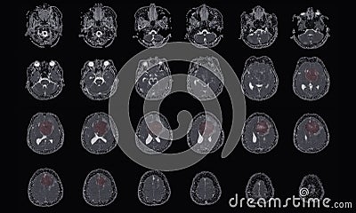 MRI BRAIN Finding of meningioma arising from anterior falx cerebri, extending to bilateral frontal regions, with adjacent minimal Stock Photo