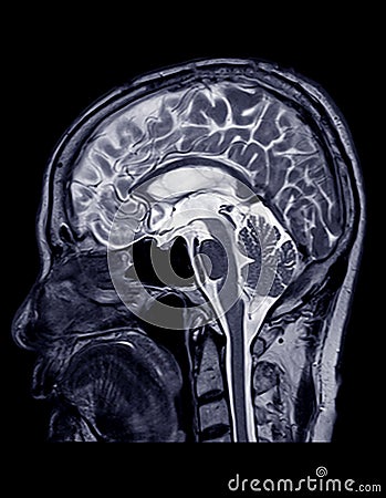 MRI of the brain sagittal plane. Stock Photo