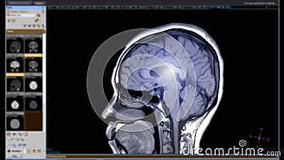 MRI of the brain Sagittal T1 Stock Photo