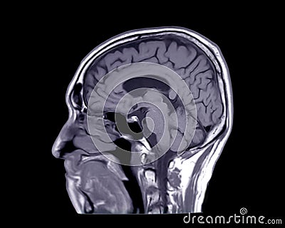 MRI of the brain sagittal T1 view Stock Photo