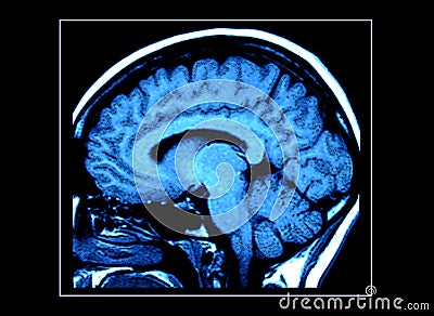 MRI Brain Scan Stock Photo