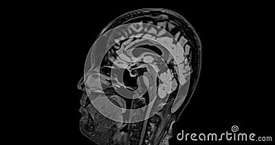 MRI brain scan sagittal flair for detect Brain diseases sush as stroke disease, Brain tumors and Infections Stock Photo