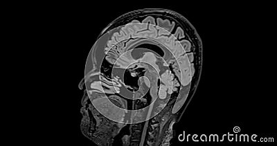 MRI brain scan sagittal flair for detect Brain diseases sush as stroke disease, Brain tumors and Infections Stock Photo