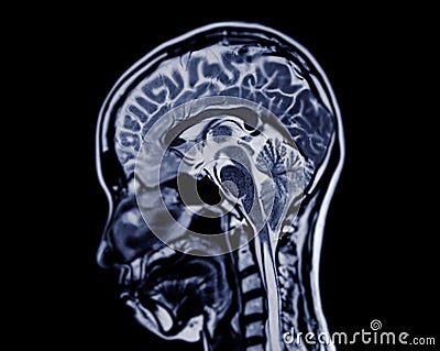 MRI brain scan sagittal plane for detect Brain diseases sush as stroke disease, Brain tumors and Infections Stock Photo