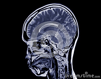 MRI brain scan sagittal plane for detect Brain diseases sush as stroke disease, Brain tumors and Infections Stock Photo