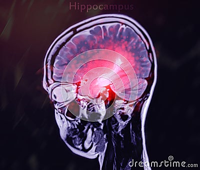 MRI brain scan sagittal plane for detect Brain diseases sush as stroke disease, Brain tumors and Infections Stock Photo