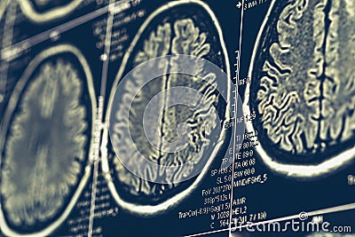 MRI brain scan or x-ray neurology human head skull tomography test Stock Photo