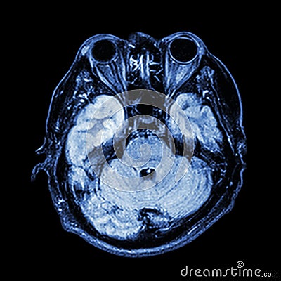 MRI brain : show lower part of brain Stock Photo