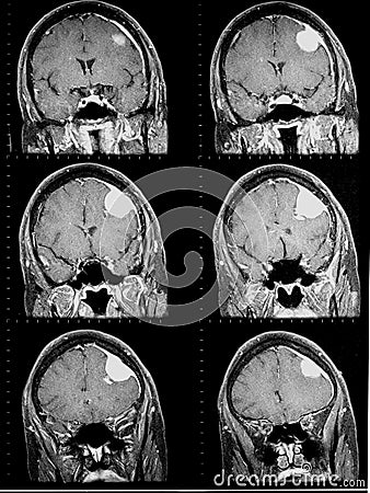 Mri of brain showing brain tumor Stock Photo