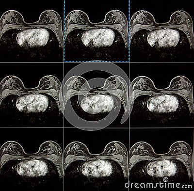 MRI of breast - breast cancer Stock Photo