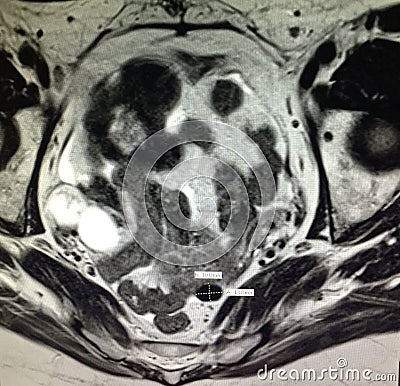 Fallopian tube neoplasm hematosalpinx pathology Stock Photo