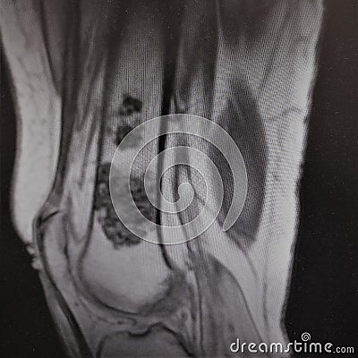 Mri femoral bone oncology sarcoma Stock Photo